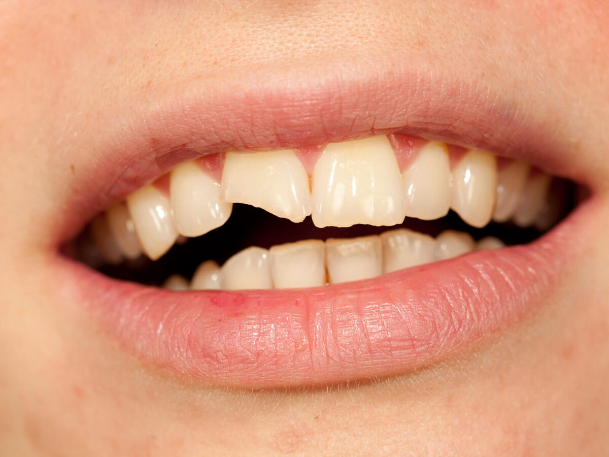 Cracked Teeth